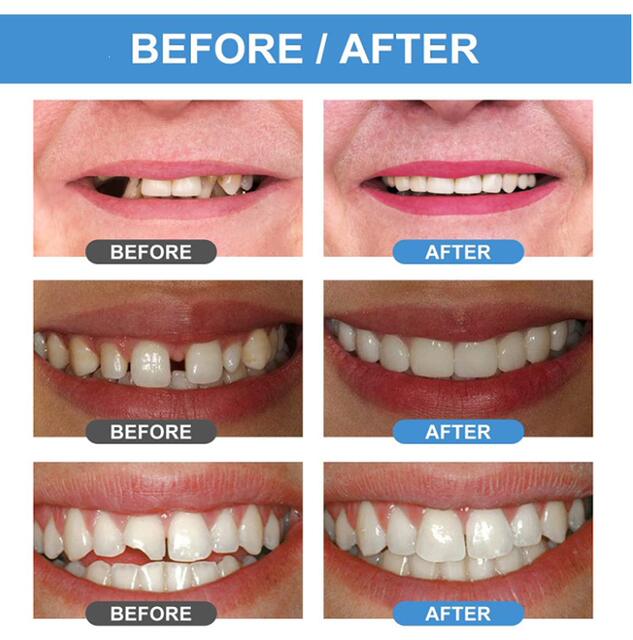 Cross-Border Export Oral Care Kit Denture Resin Teeth Missing Teeth Front Teeth Gaps Tooth Holes Braces Material Glue detail 6