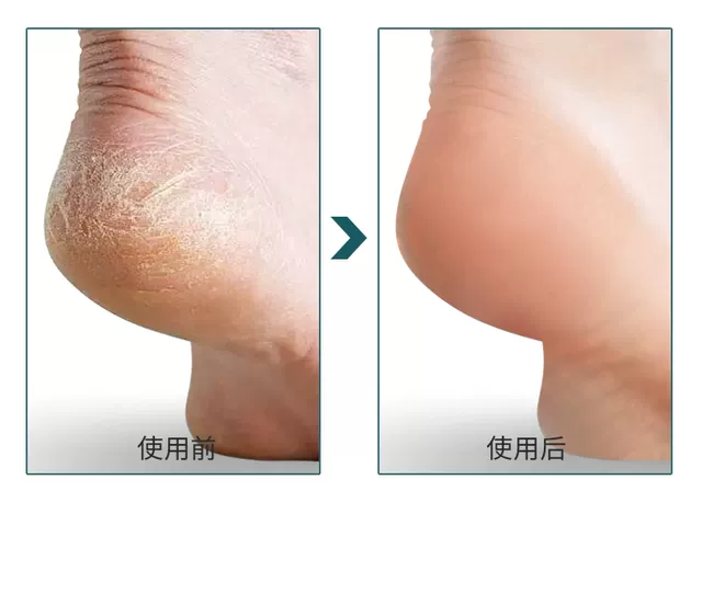 Pedicure Artifact to remove dead skin calluses household heel scraping sole foot grinding stone knife foot skin grinding device foot rubbing board detail 3